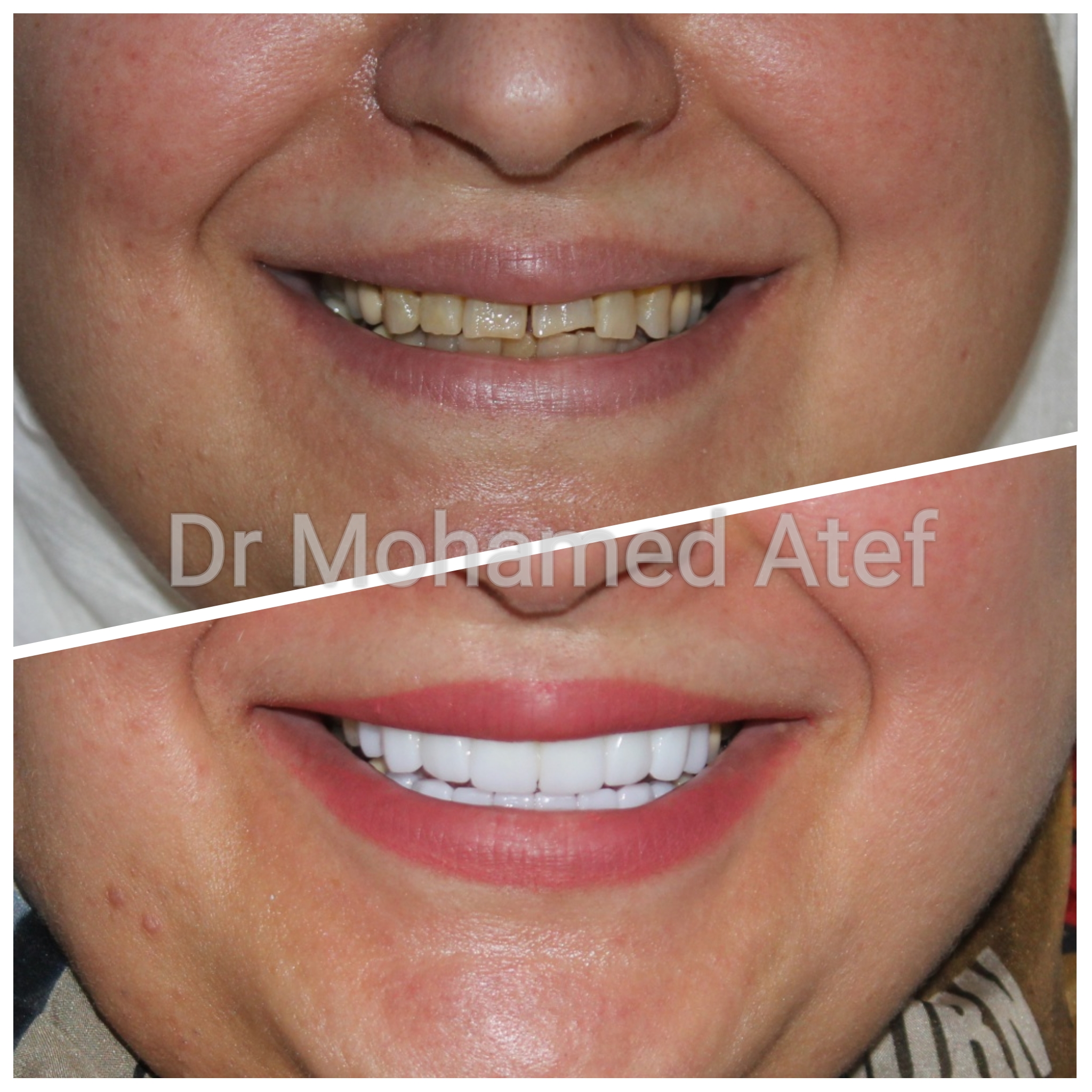 Before Image - Our Invisalign Patients Love Smiling