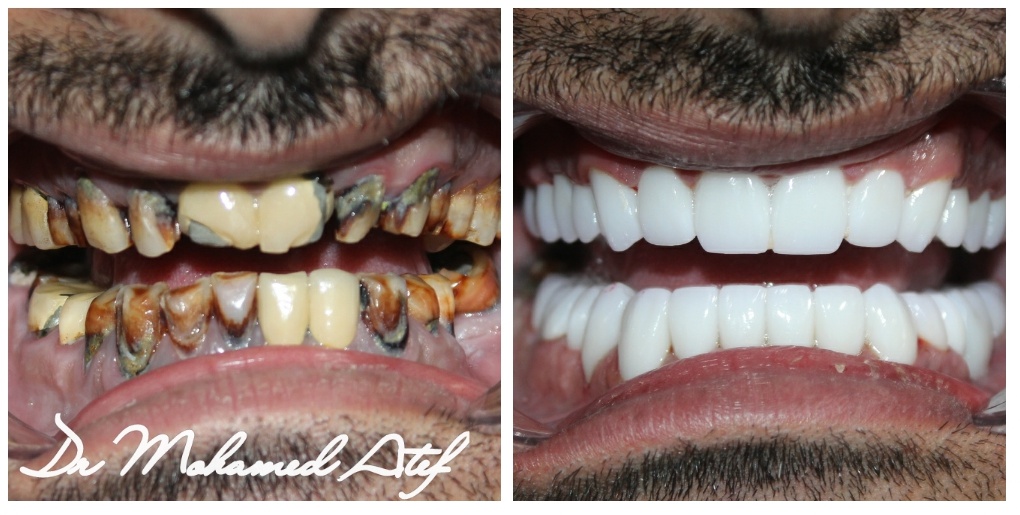 Before Image - Our Invisalign Patients Love Smiling