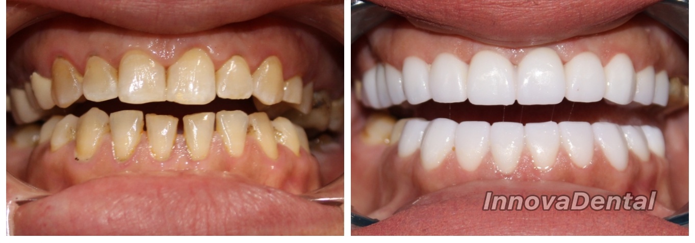 Before Image - Our Invisalign Patients Love Smiling