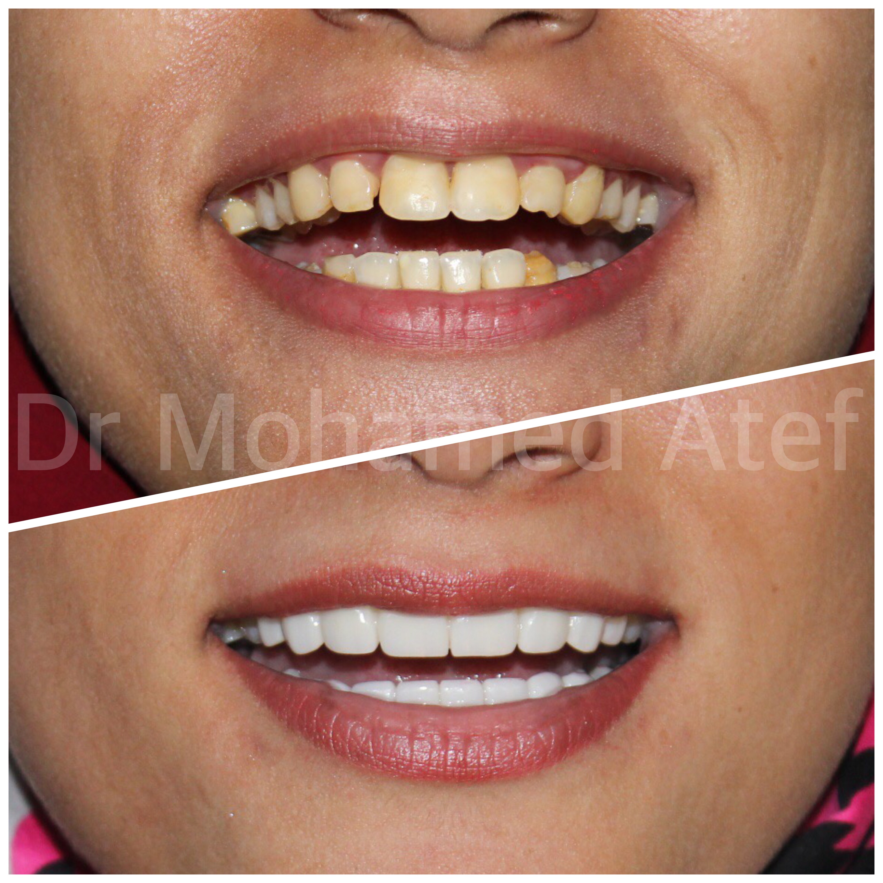 Before Image - Our Invisalign Patients Love Smiling