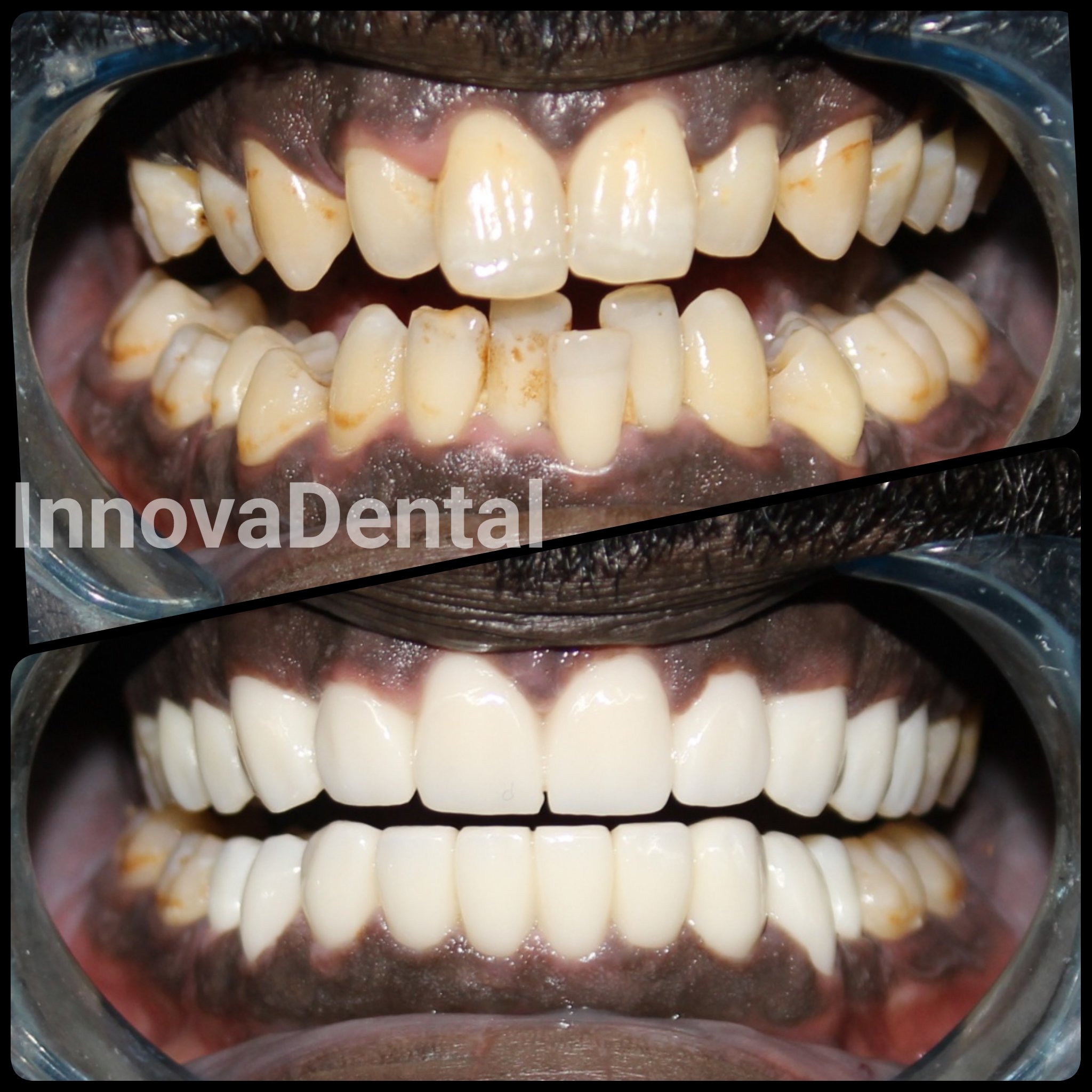 Before Image - Our Invisalign Patients Love Smiling