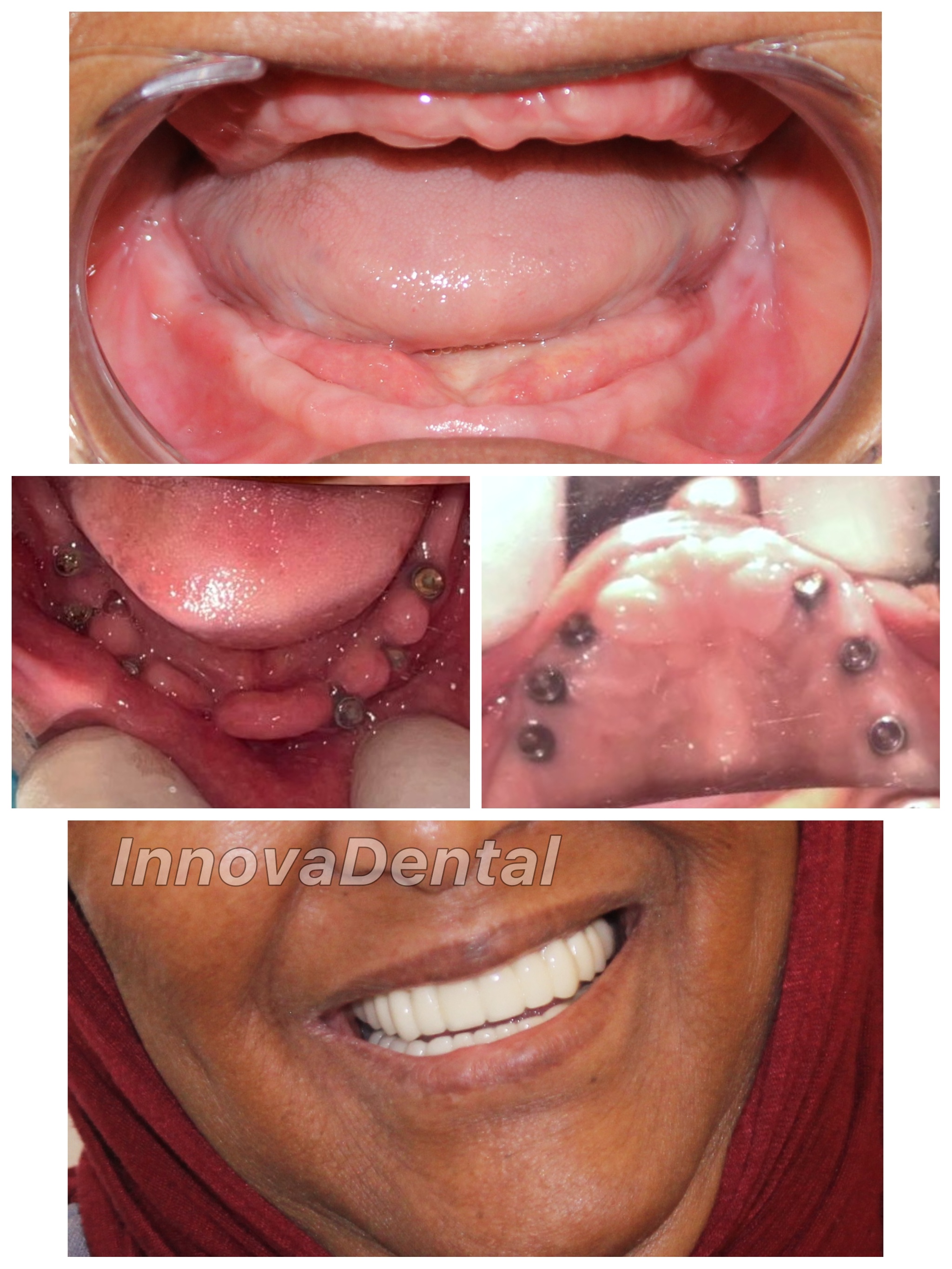 Dental implants