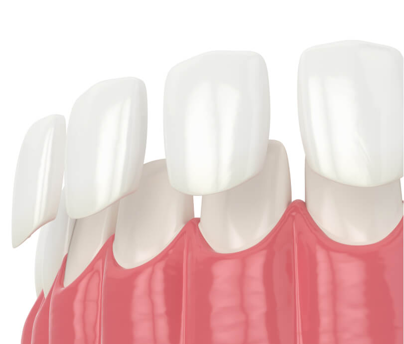3D Render of Veneers